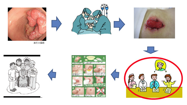 ケースレポート 大腸がん術後合併症患者を退院へ導くことのできた私たちの看護体験 伊賀市立上野総合市民病院 看護部