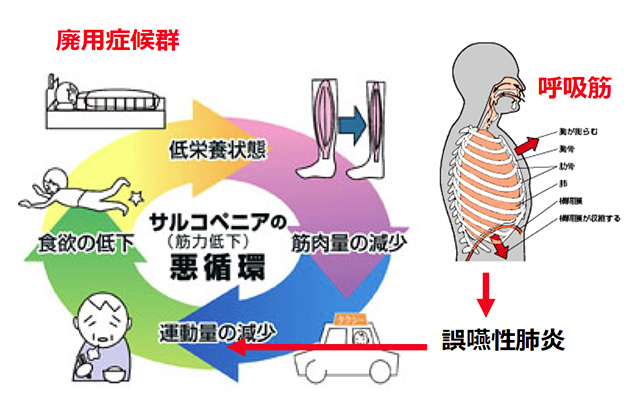 研究課題 サルコペニアの悪循環を断つ 伊賀市立上野総合市民病院 看護部